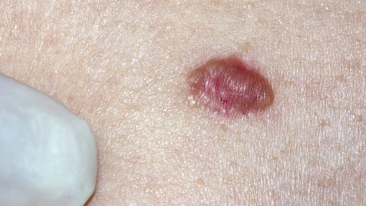 Carcinoma Basocelular: O Câncer de Pele Mais Comum e Como Tratar
