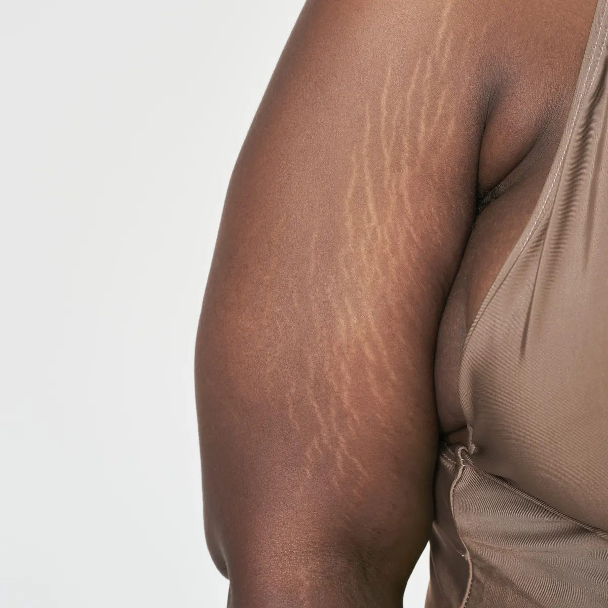 Estrias: Causas, Tipos e os Melhores Tratamentos Dermatológicos
