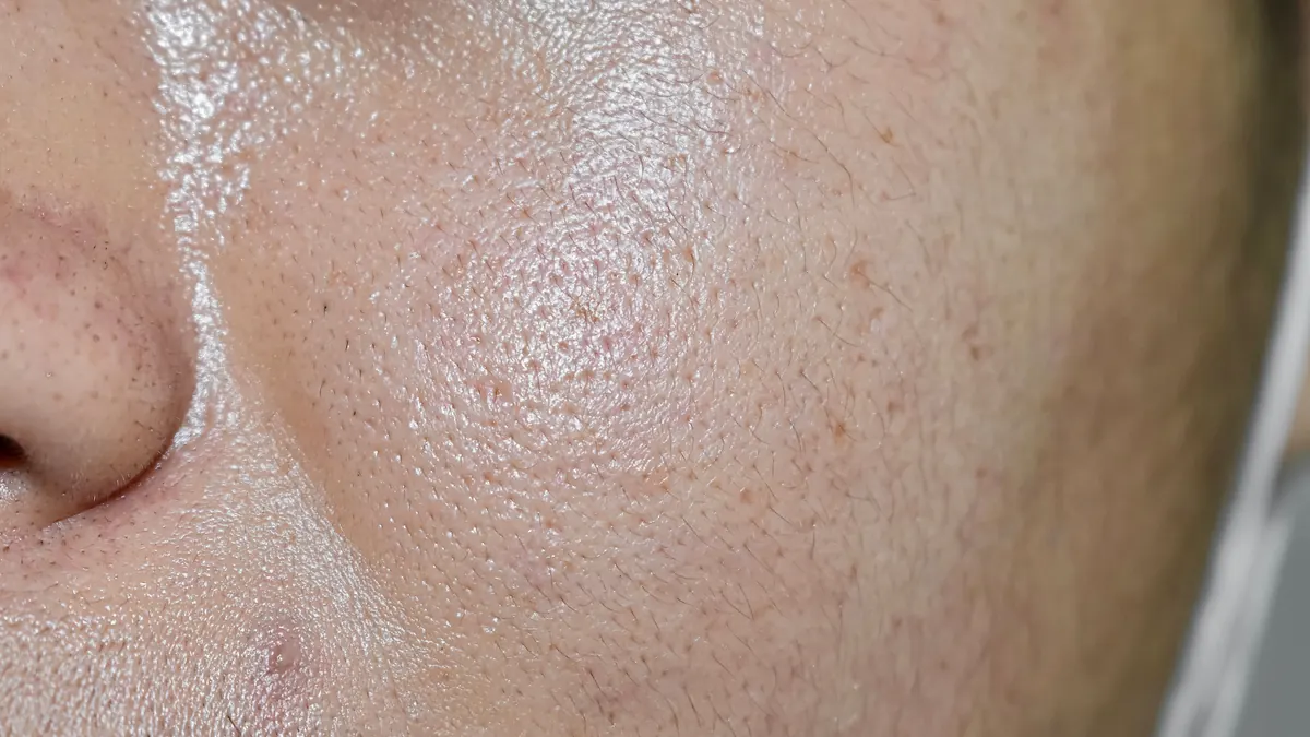 Pele Oleosa e Seborréia: Causas, Cuidados e Tratamentos Dermatológicos