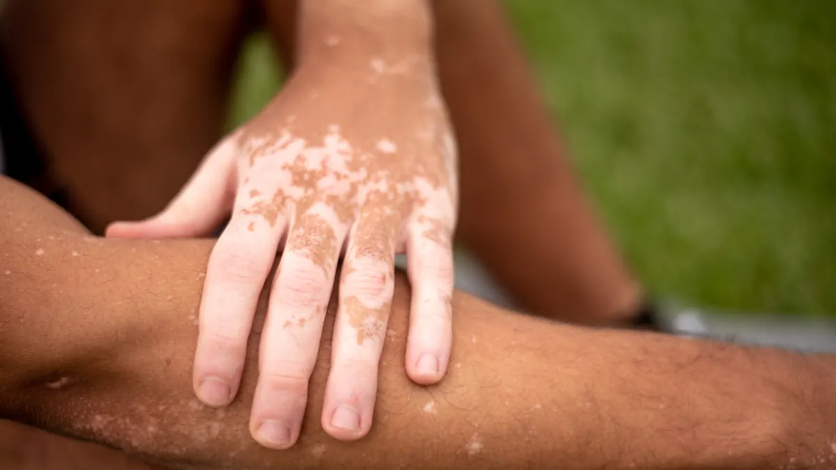 Vitiligo: Causas, Tipos, Tratamentos e Qualidade de Vida